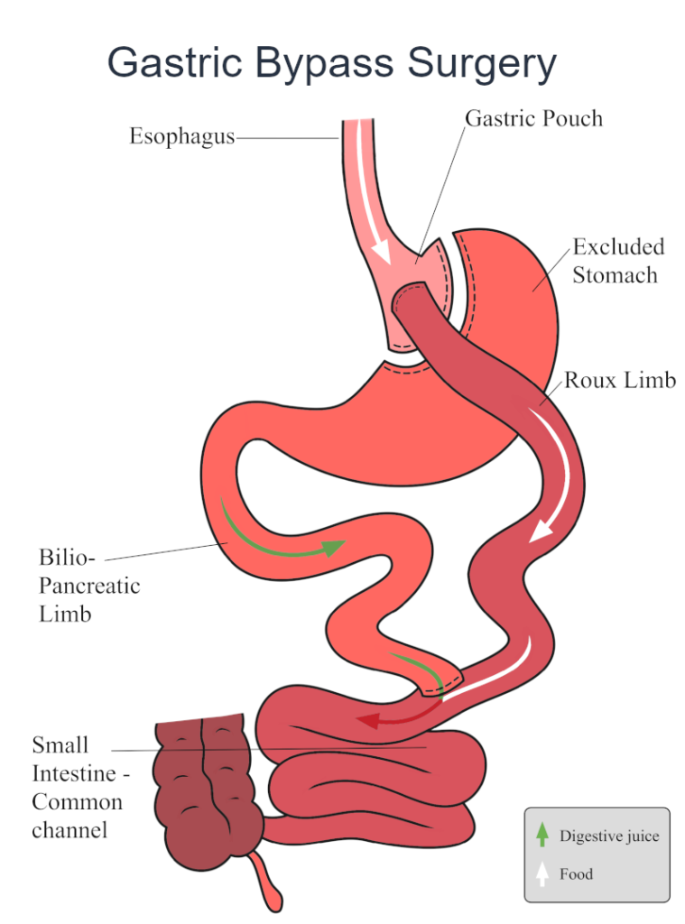 Gastric Bypass Surgery