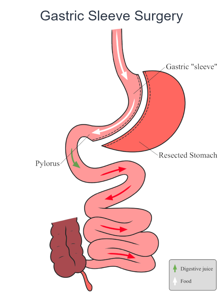 Gastric sleeve surgery