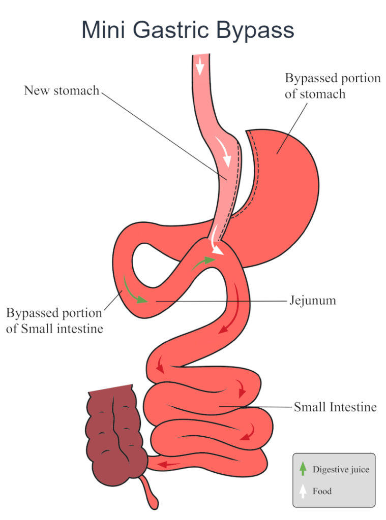 Mini Gastric Bypass