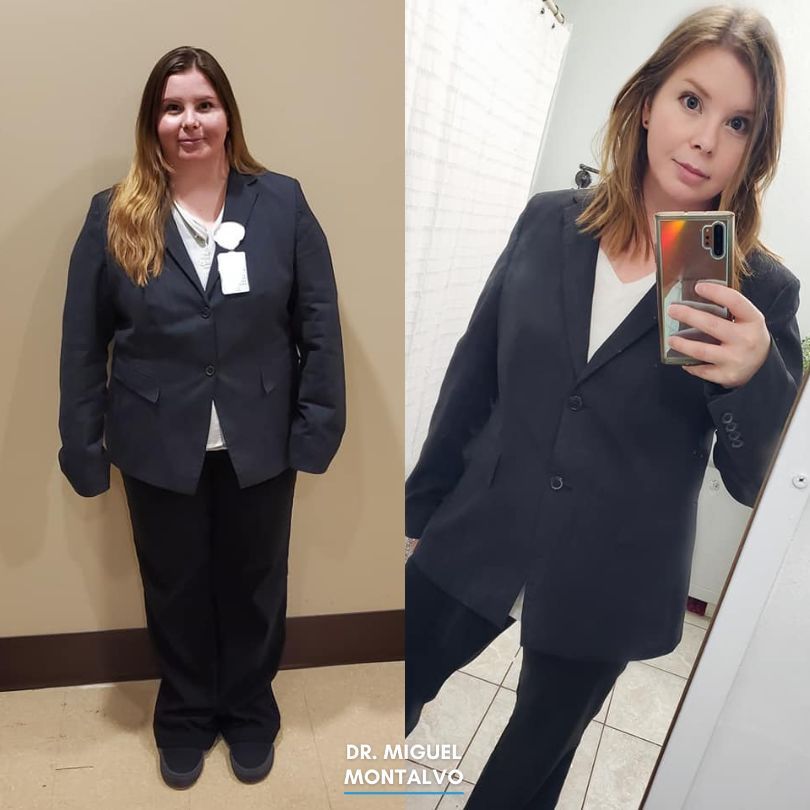 Stephanie L Before and After Gastric Sleeve -Dr. Miguel Montalvo